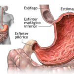 Escucha a tu estómago para prevenir el cáncer
