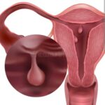 Cáncer de endometrio: avances permiten tratamientos más personalizados